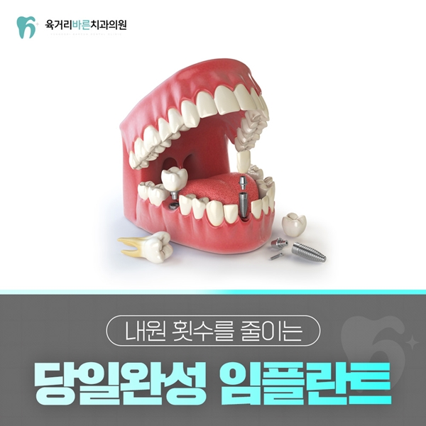 당일완성 임플란트로 내원 횟수 줄이기