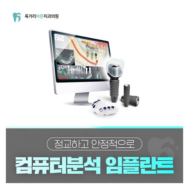 정교하고 안정적인 컴퓨터 분석 임플란트