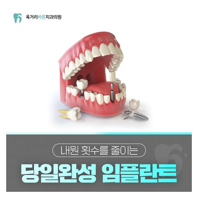 내원 횟수를 줄이는 당일완성 임플란트 진료